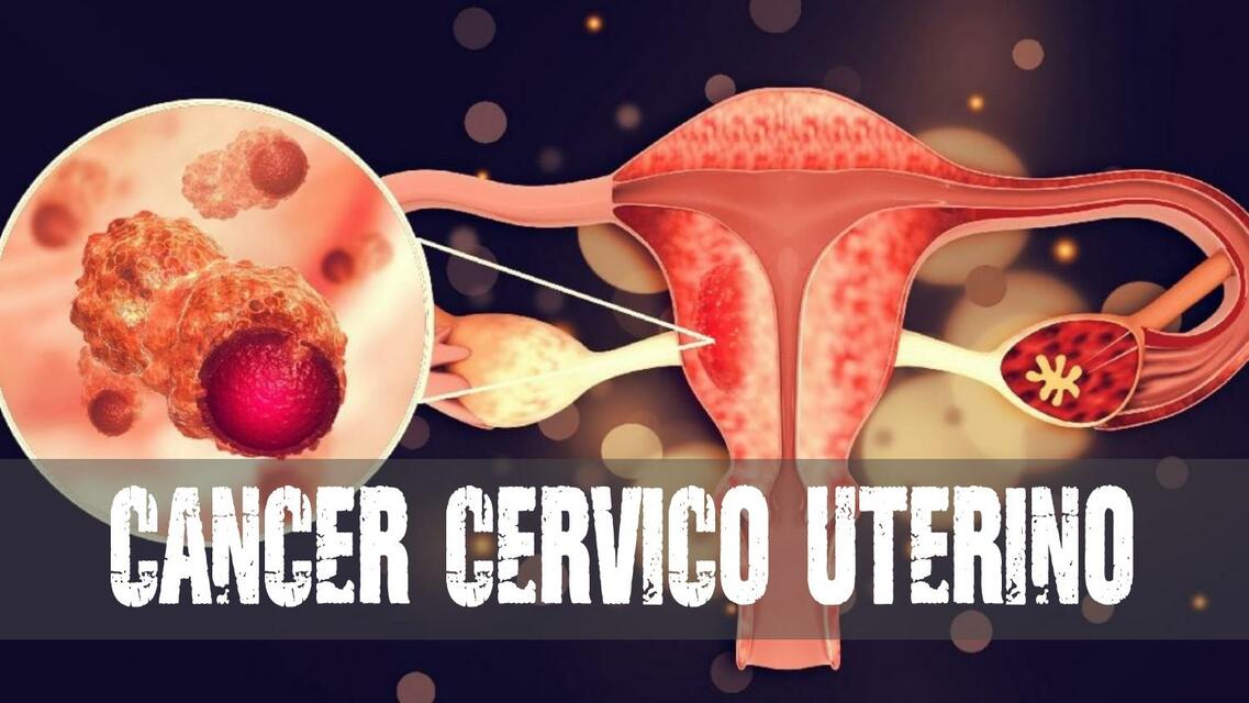 CANCER DE CUELLO UTERINO