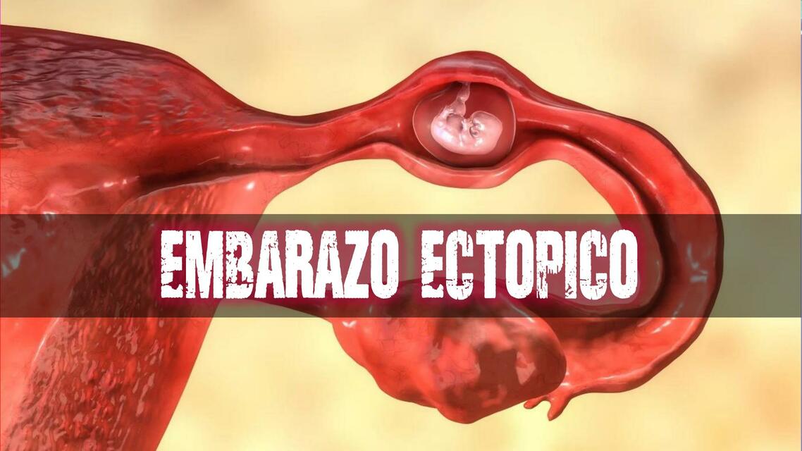 EMBARAZO ECTOPICO