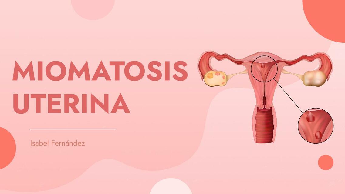 Miomatosis uterina