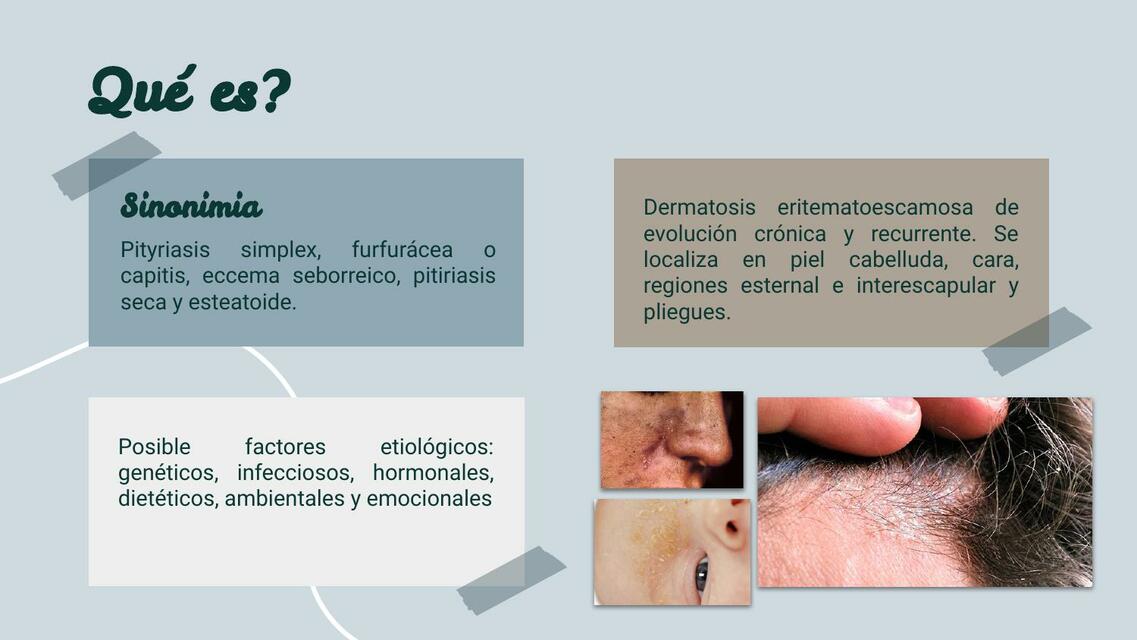 Dermatitis Seborreica