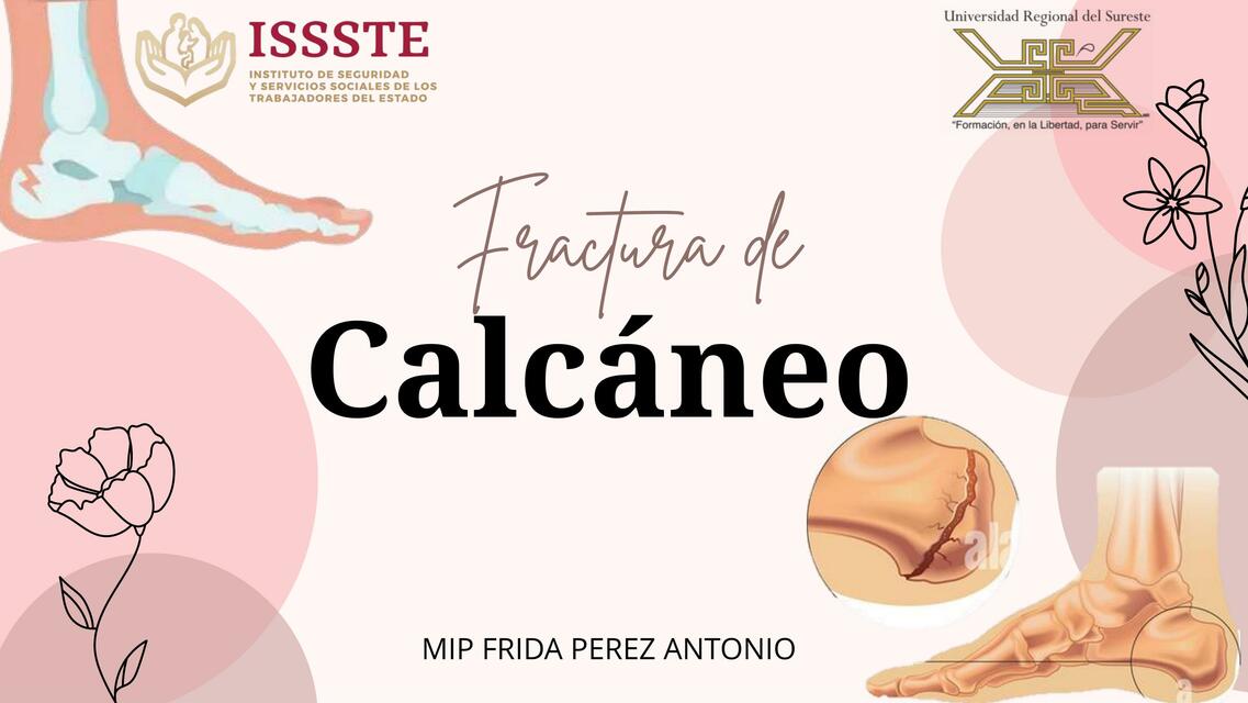 Fractura de calcaneo