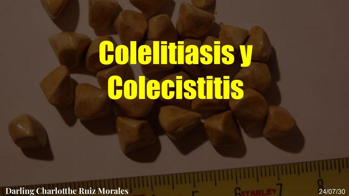 Colelitiasis y colecistitis