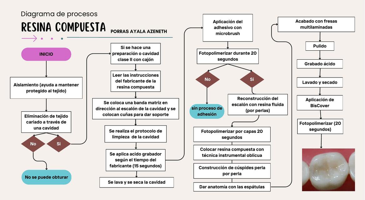 Resina compuesta mapa