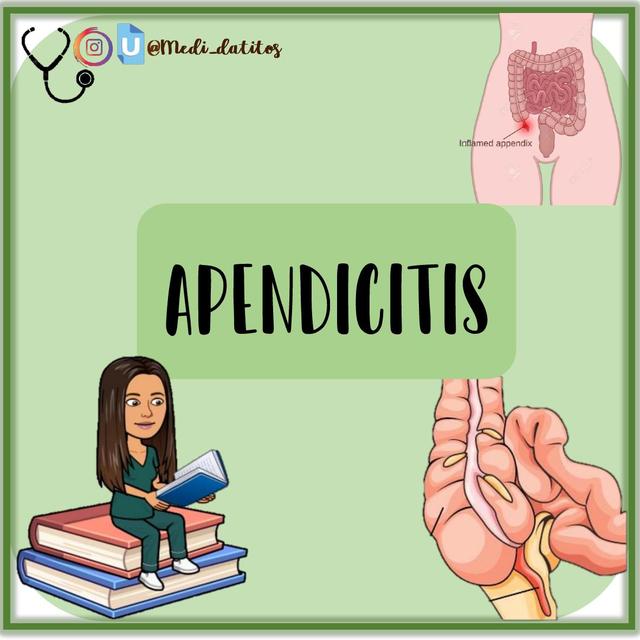 CIRUGÍA GENERAL - APENDICITIS