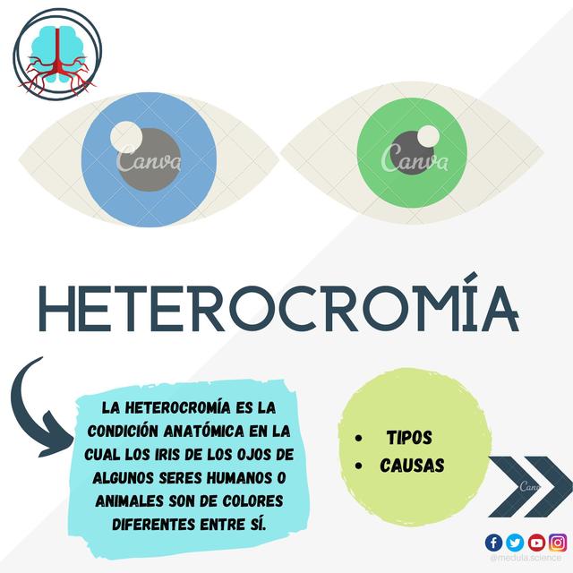 Heterocromía. ALTERACIONES DEL COLOR DEL IRIS