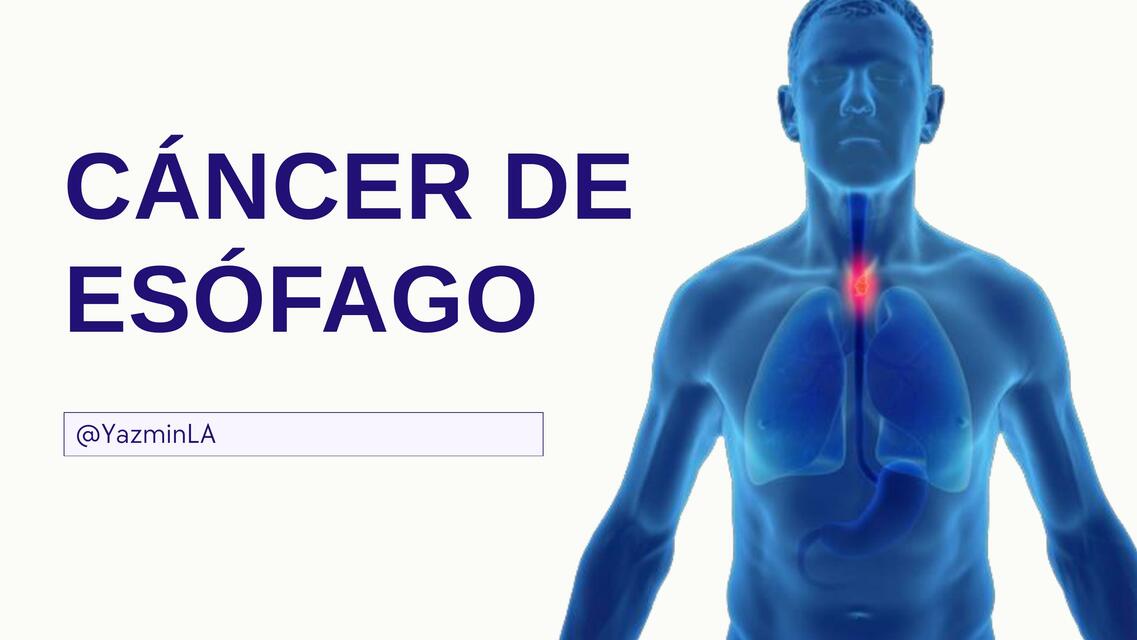 Presentación sobre cáncer de esófago