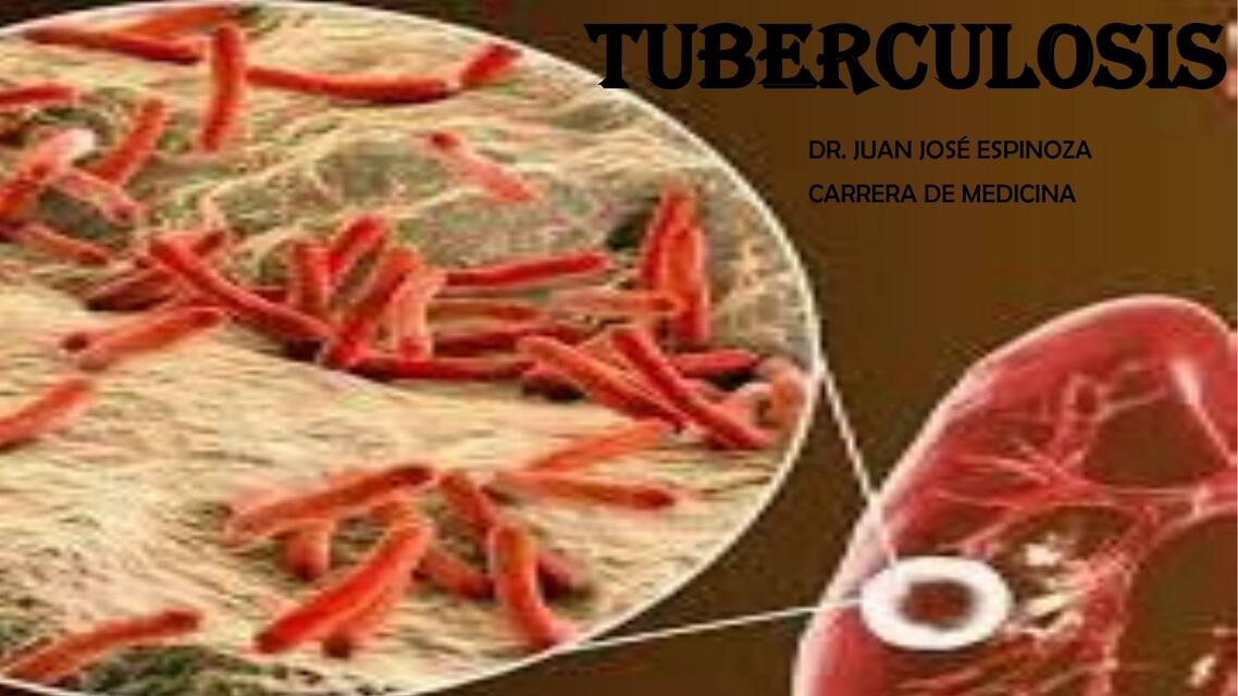 TUBERCULOSIS