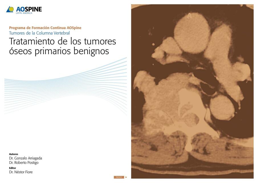 Tratamiento de los tumores óseos primarios benigno