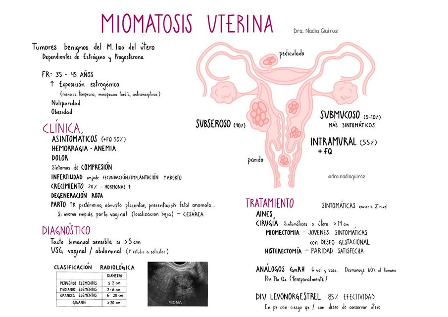 Míomatosis Uterina