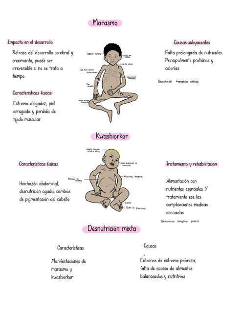 Desnutrición infantil