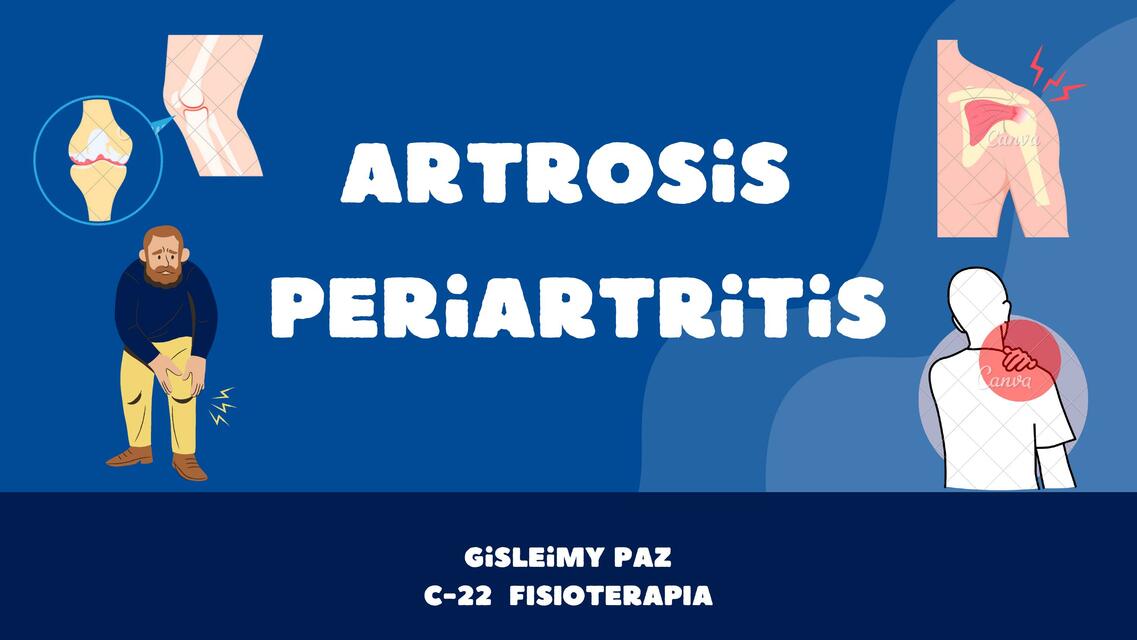 Artrosis Periartritis Exposición