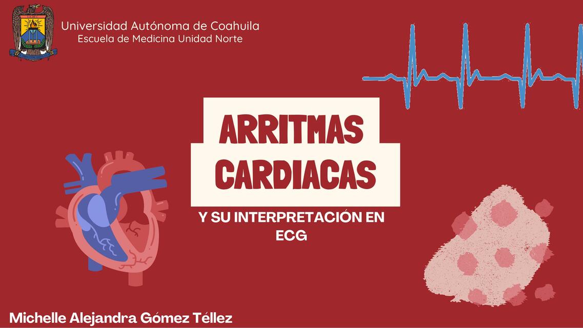 ARRITMIAS Y SU INTERPRETACIÓN EN ECG