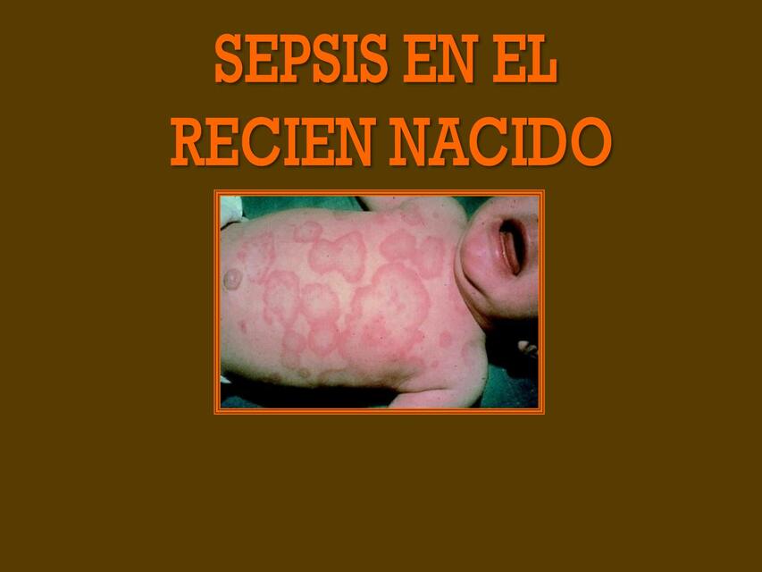 SEPSIS NEONATAL