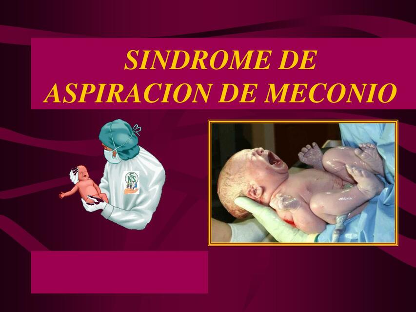 SINDROME DE ASPIRACION DE MECONIO