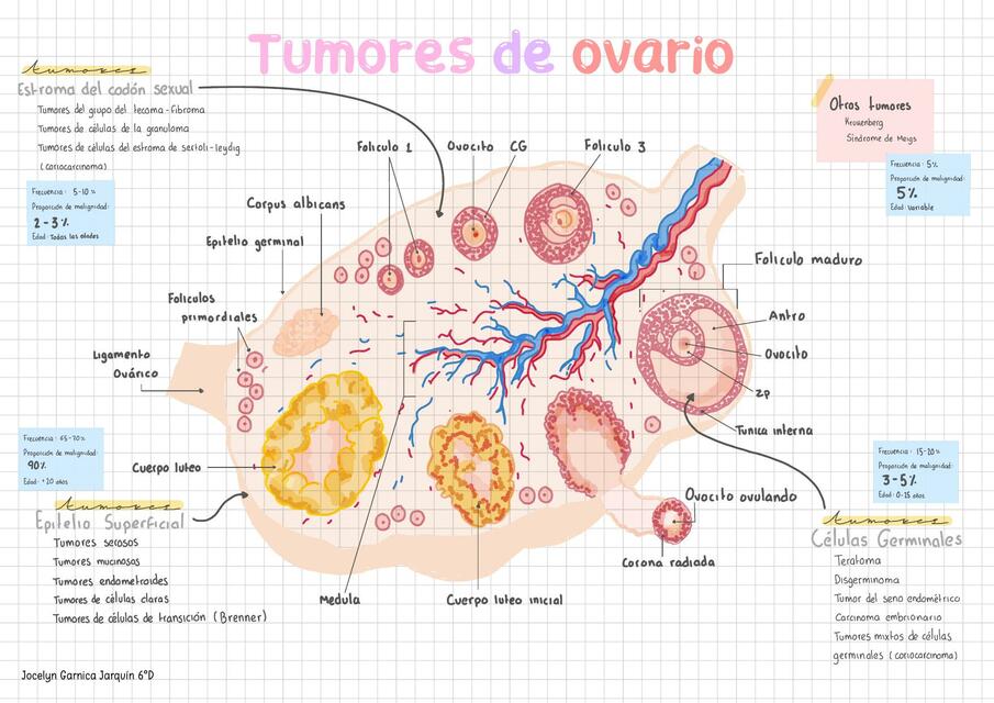 Tumores de ovario