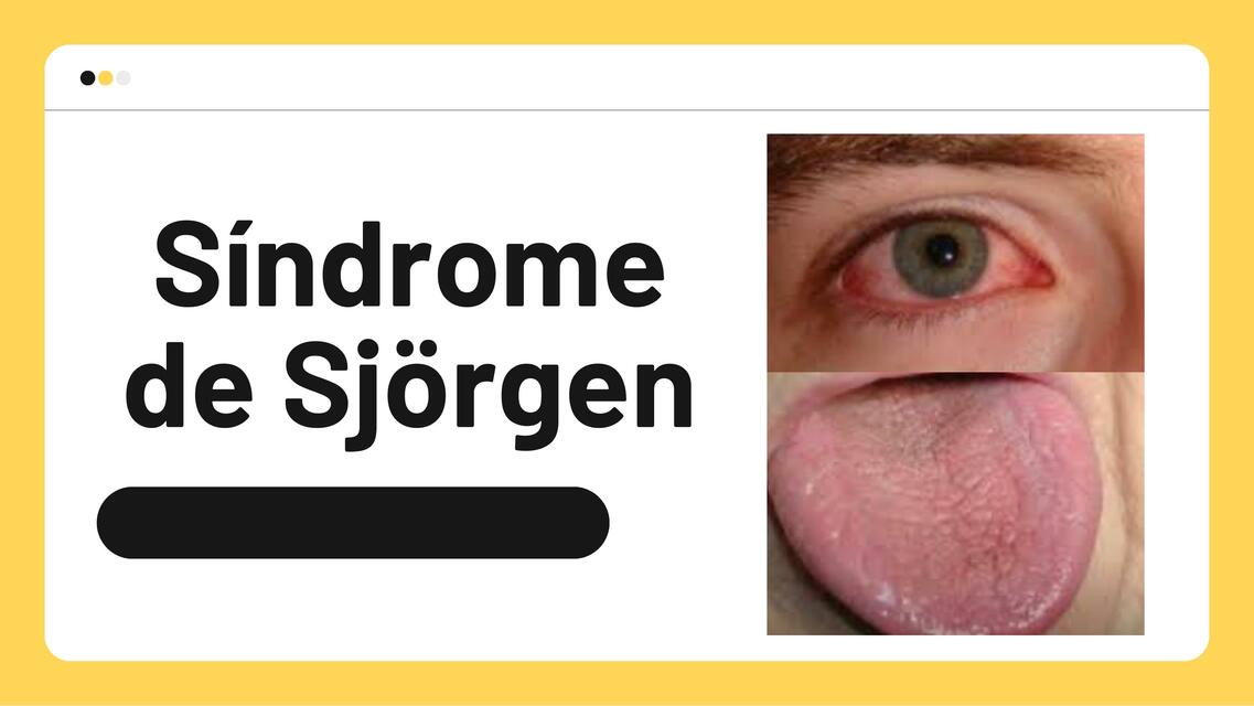 Síndrome de Sjogren