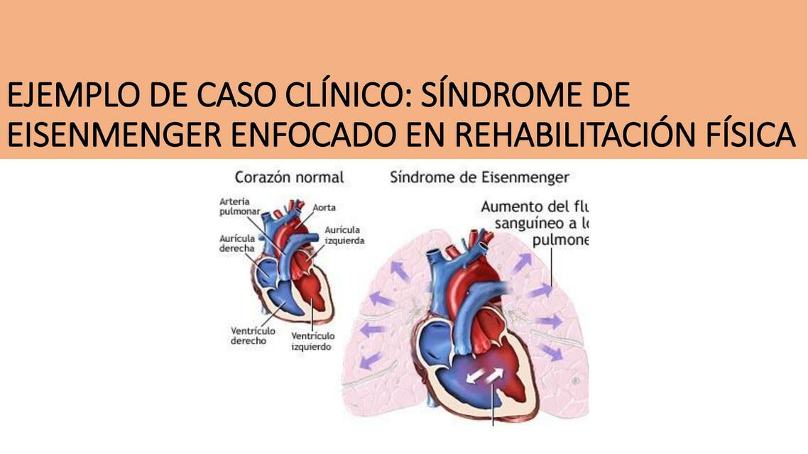 EJEMPLO DE CASO CLÍNICO SINDROME DE EISEGNMENGER | B.M.GFisioterapia ...