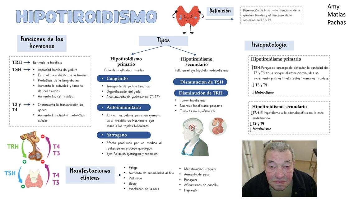 ESQUEMA DEL HIPOTIROIDISMO | Amy Brigit Matias | uDocz
