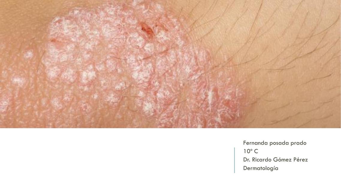 PSORIASIS