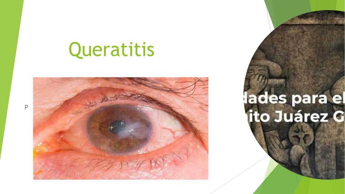 Queratitis