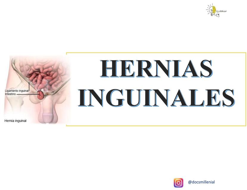 RESUMEN HERNIAS INGUINALES CX