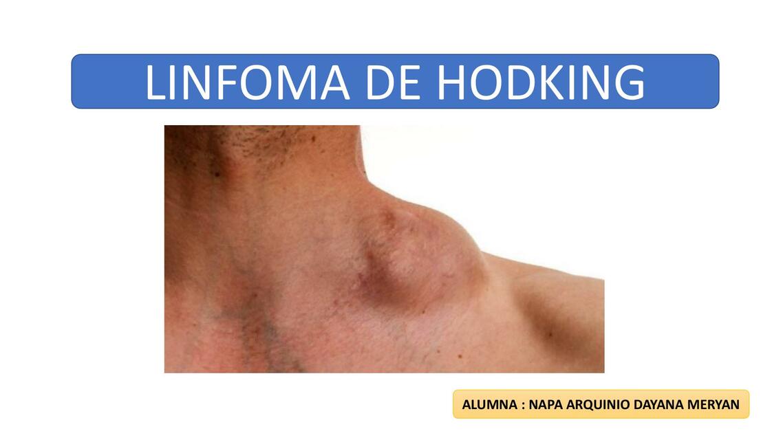 linfoma de hodkin g EXPOSICION