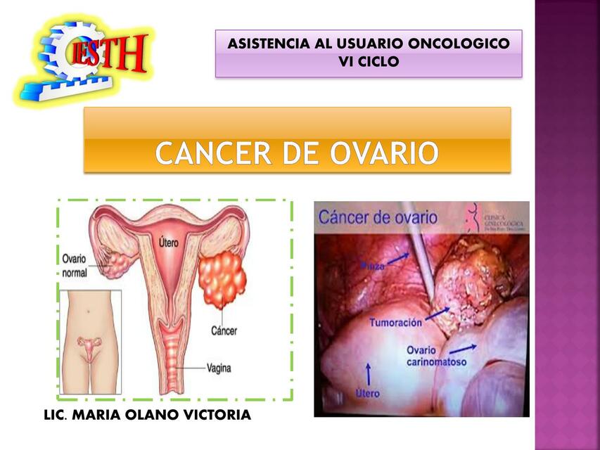 CANCER DE OVARIO