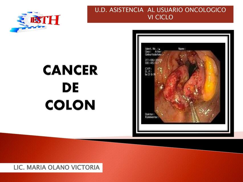 CANCER DE COLON