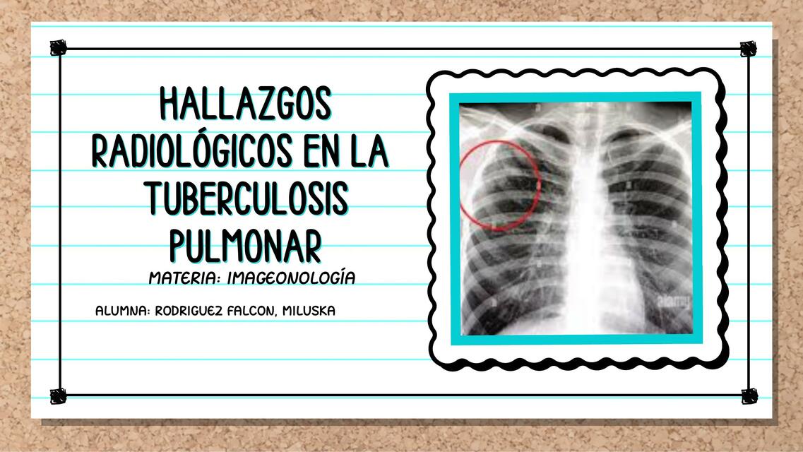 HALLAZGOS RADIOLOGICOS DE LA TUBERCULOSIS PULMONAR