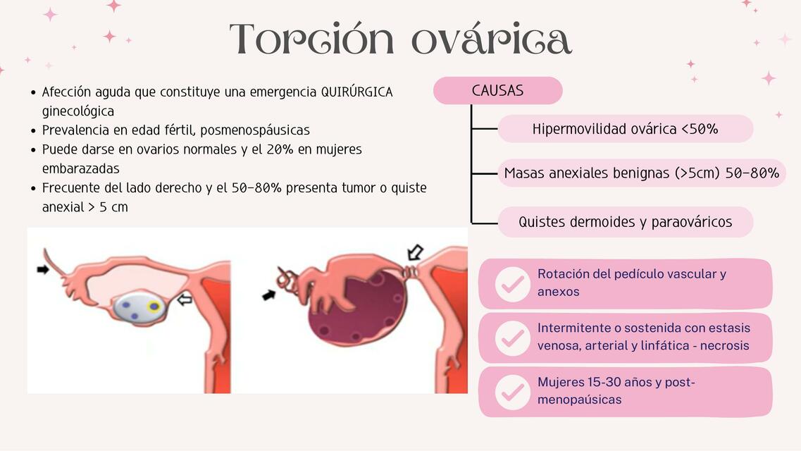 Torción ovárica