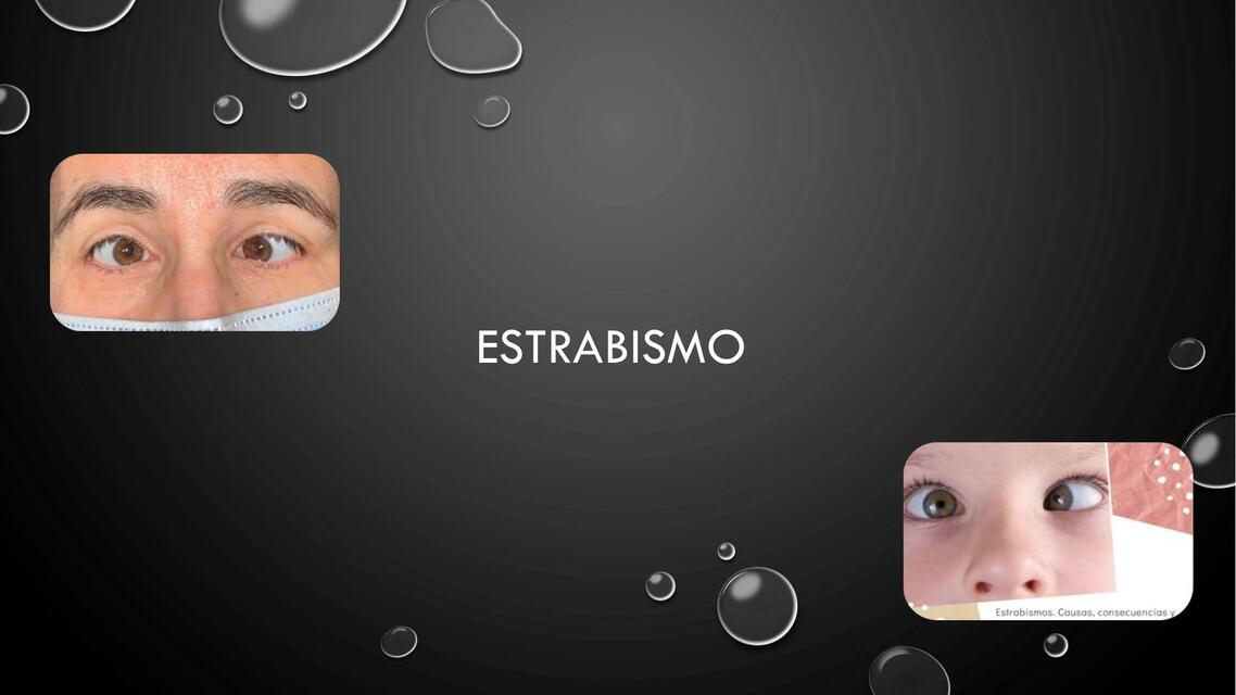 Estrabismo 1