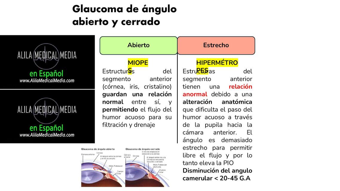 Glaucoma de ángulo abierto y ángulo cerrado