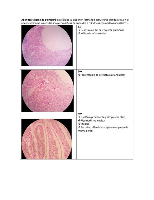 PATOLOGÍA: ADENOCARCINOMA DE PULMÓN