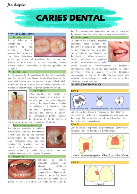 TIPOS DE CARIES DENTAL