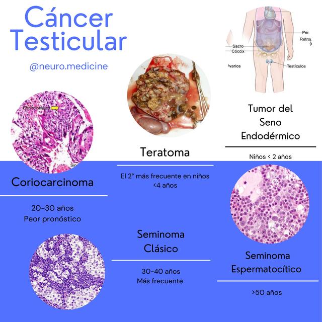 Cáncer Testicular Según Grupo De Edad Neuromedicine Udocz