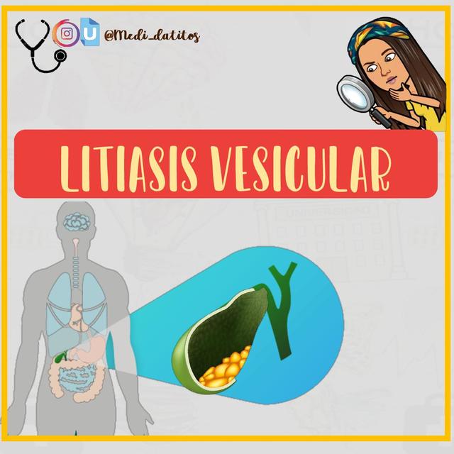 RESUMEN - LITIASIS VESICULAR 