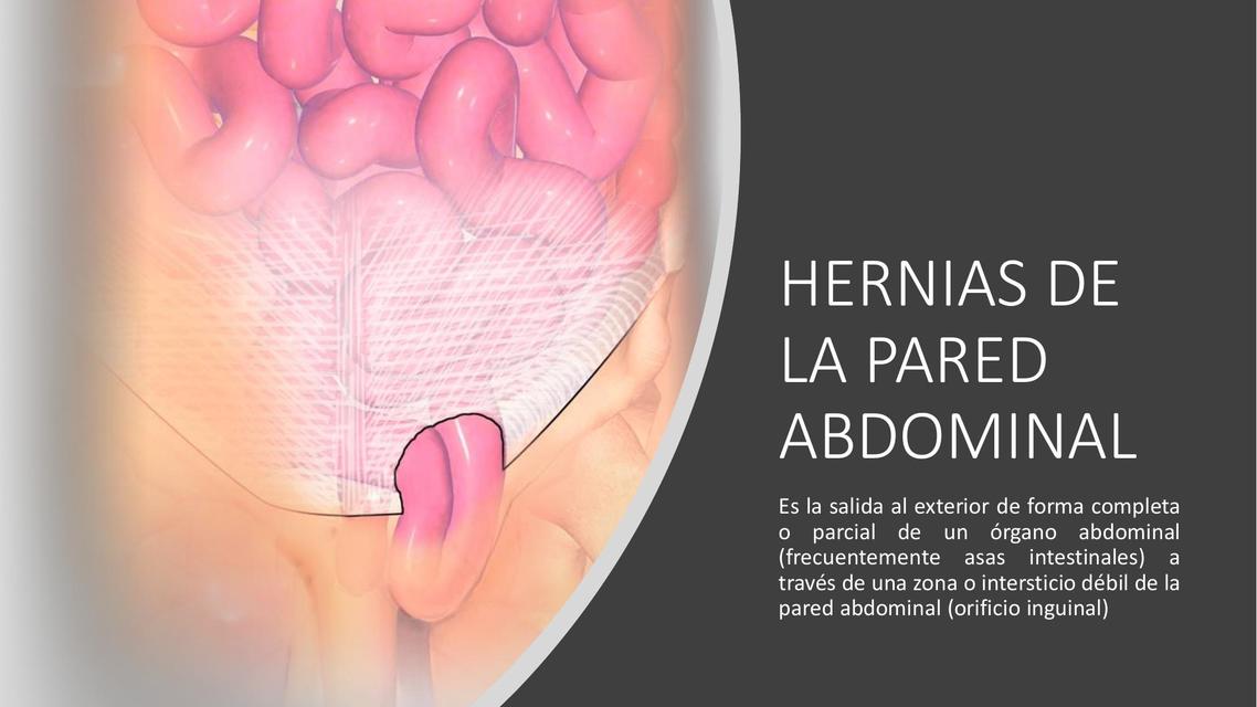 HERNIAS DE LA PARED ABDOMINAL