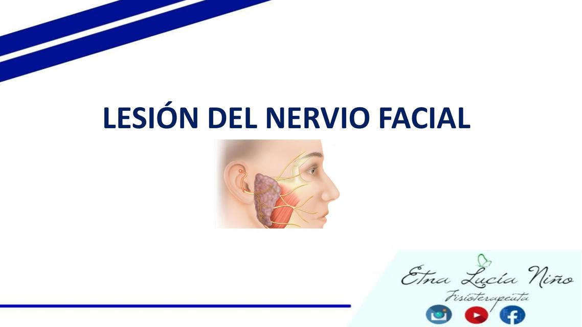 PARALISIS FACIAL