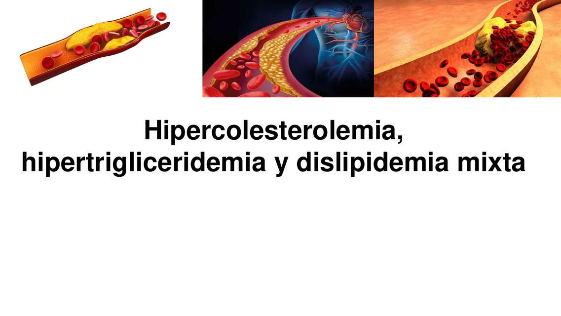 Hipercolesterolemia hipertrigliceridemia y dislipidemia mixta