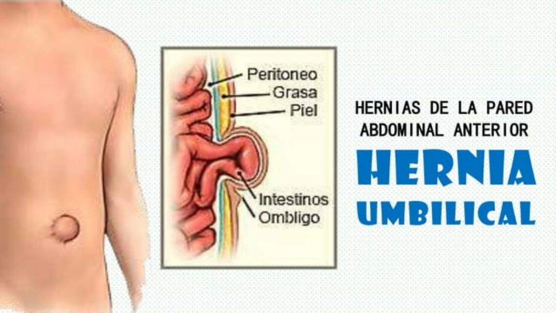 Hernia umbilical pptx