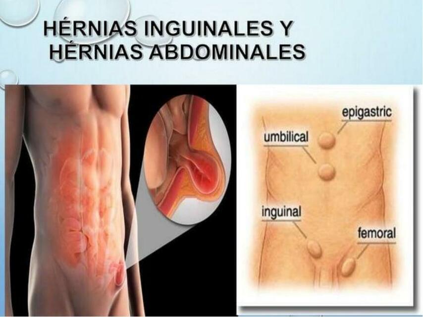 Hernias