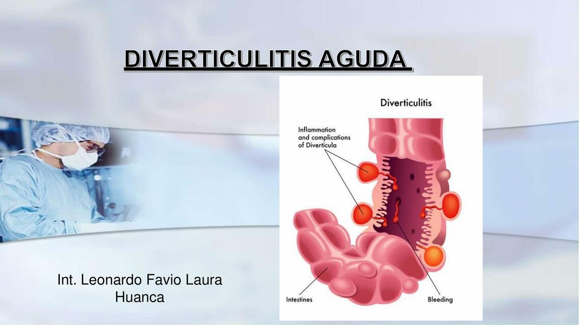 DIVERTICULITIS