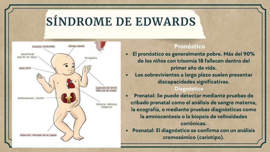 Síndrome de Edwards | ROISER TAPIA TAPIA | uDocz
