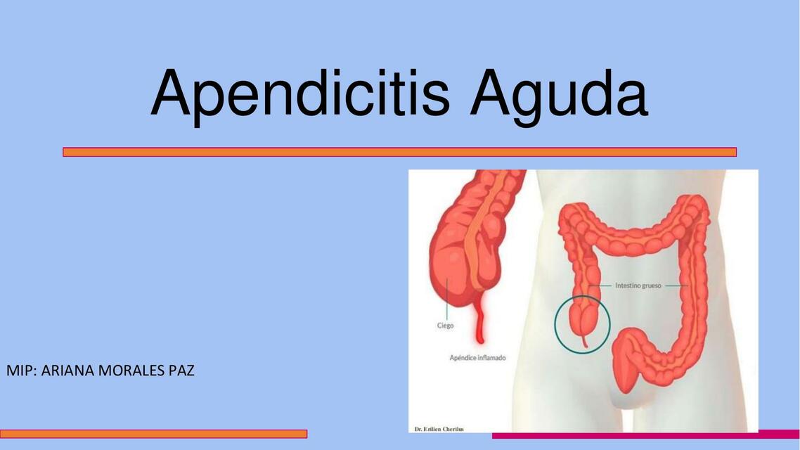 apendicitisaguda final