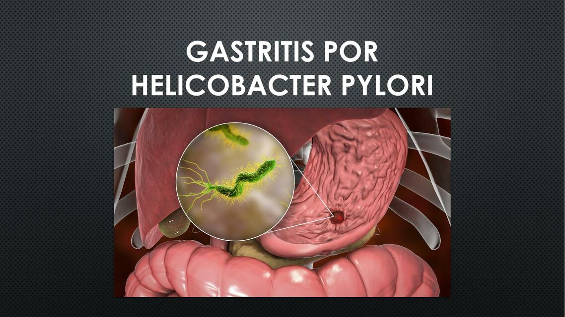 Gastritis por helicobacter pylori 