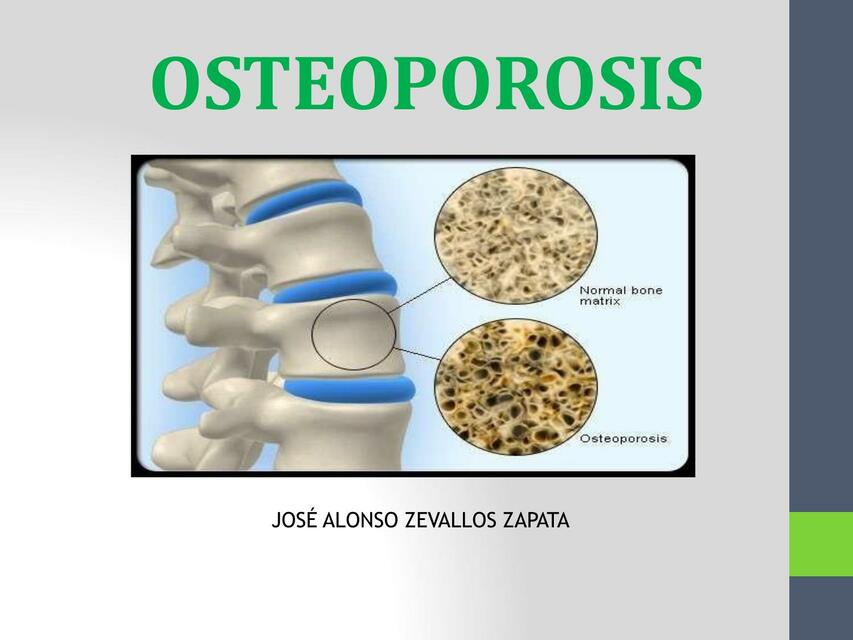 Osteoporosis