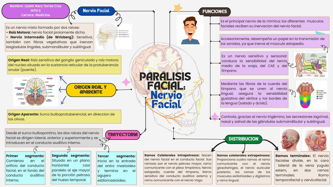 Paralisis facial