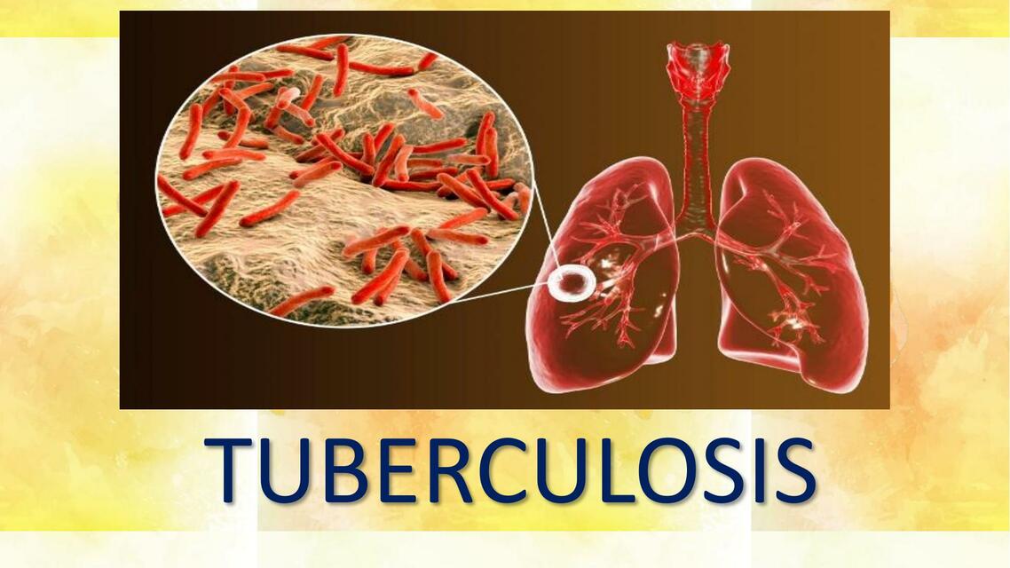 Tuberculosis