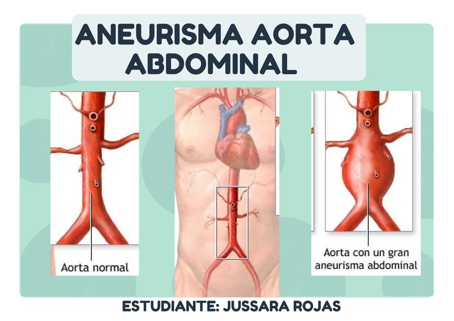 ANEURISMA AORTA ABDOMINAL pdf