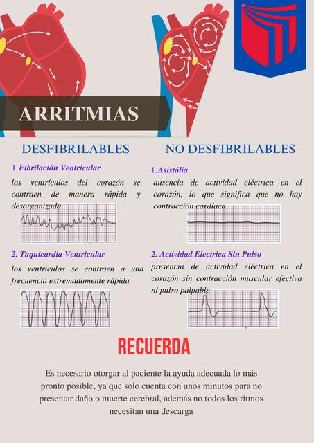 ARRITMIAS